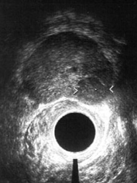 Rektal-Sonografie der Prostata